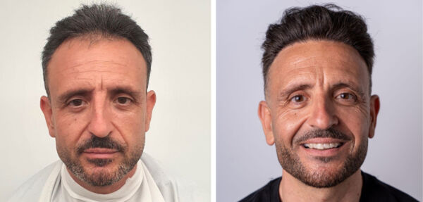 Before and After