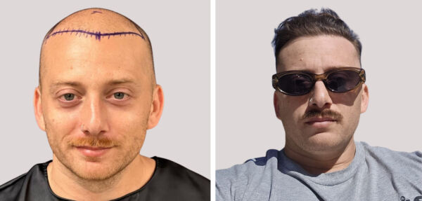 Before and After